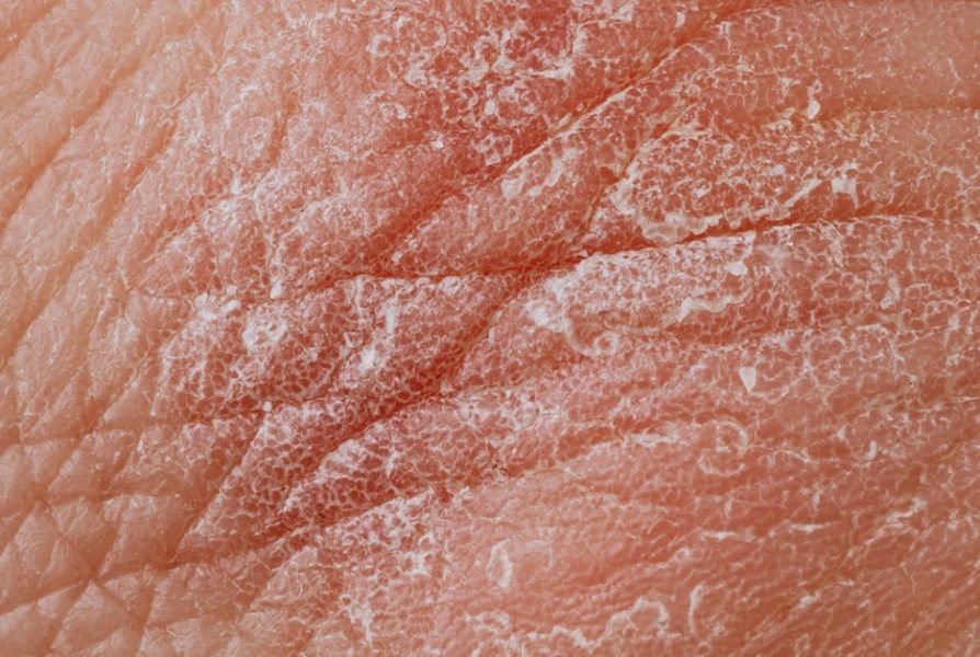 dry skin treatment advice in Neath