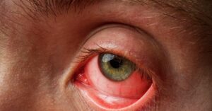conjunctivitis