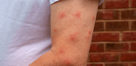 Pharmacist treating infected insect bite at The Health Dispensary Neath