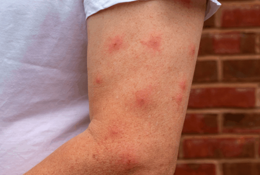 Pharmacist treating infected insect bite at The Health Dispensary Neath
