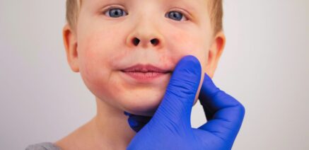 child with impetigo